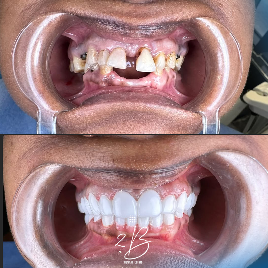 Before & After - Teeth Whitening Transformation