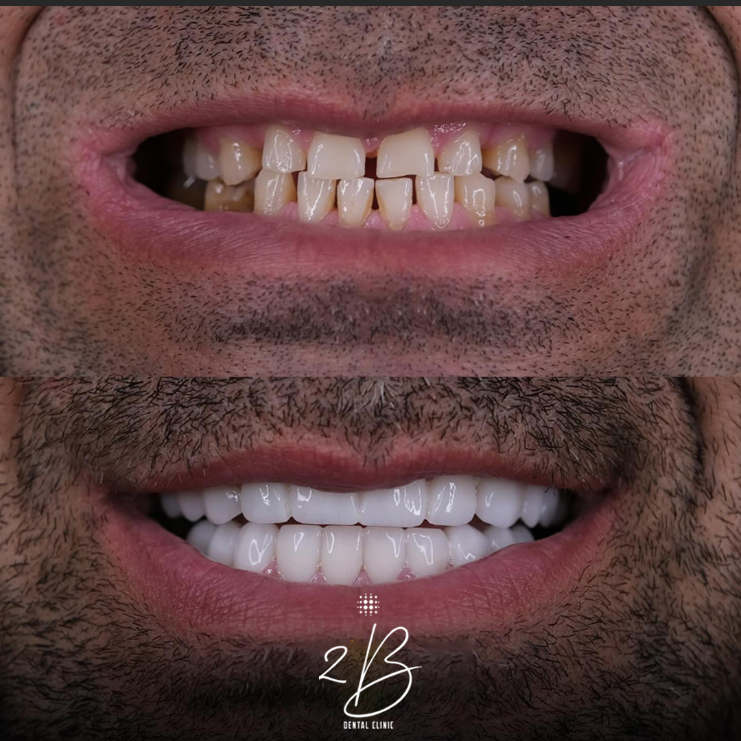 Before & After - Dental Implant Transformation